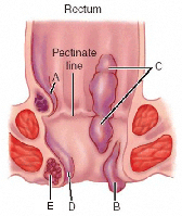 hemorrhoids