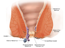 Treat Hemorrhoids